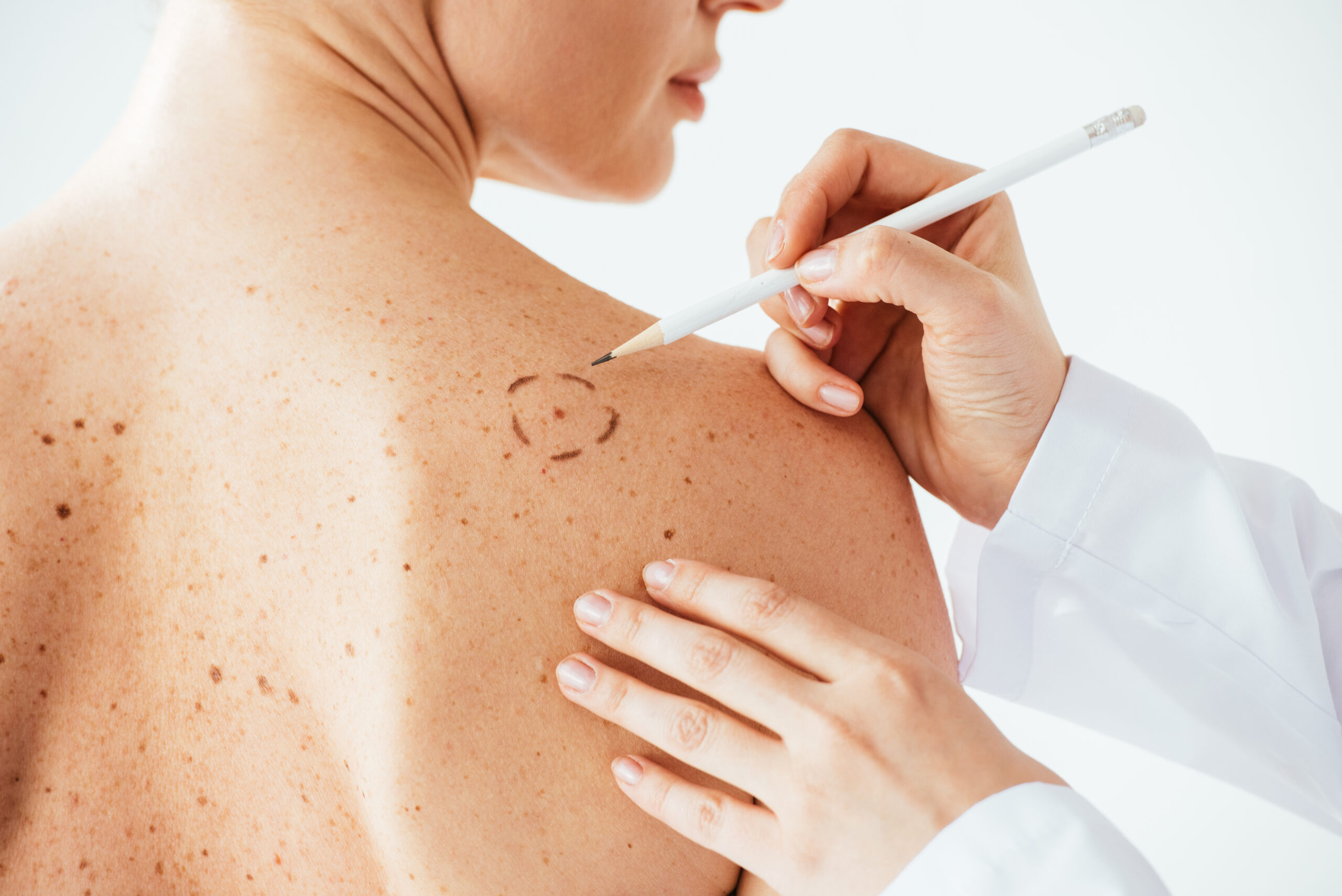 Skin Cancer Treatment Raleigh Nc